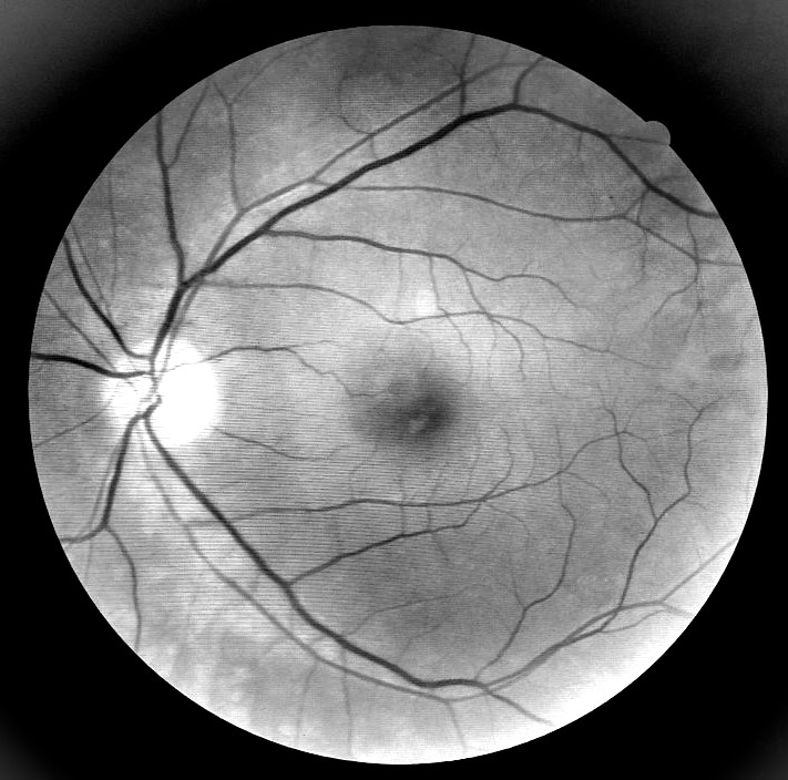 project Retinal Scan Segmentation image thumbnail